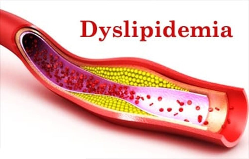 Dyslipidemia In Diabetes