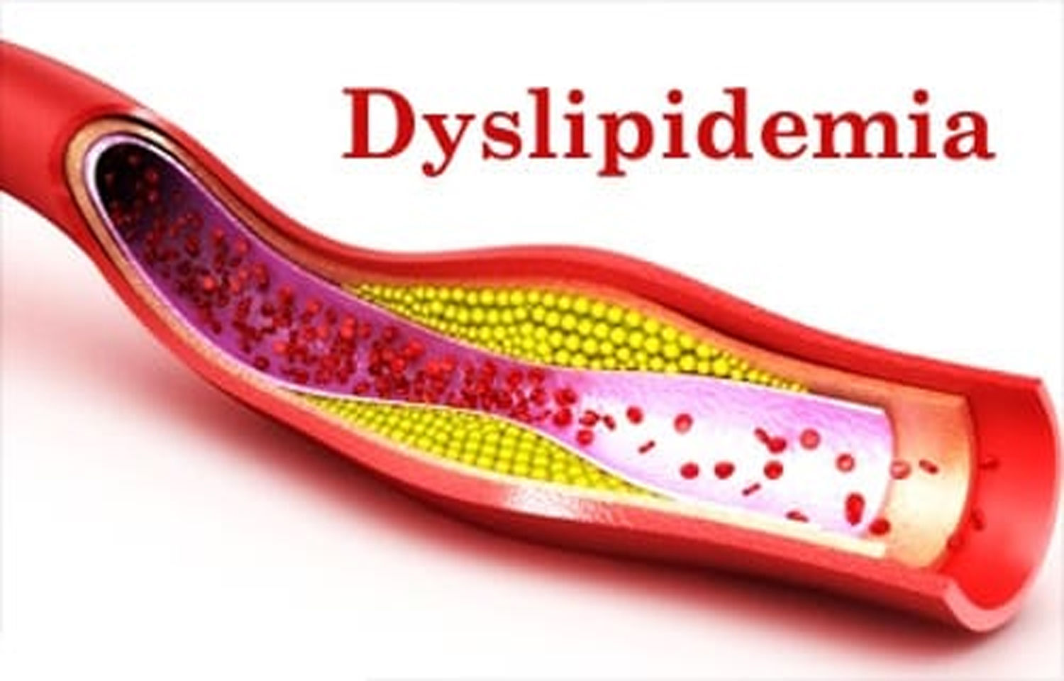Dyslipidemia in Diabetes